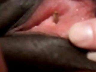 Maggot entering black woman's urethra!