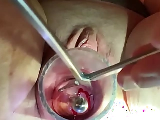 Dilating to 9mm w Tenaculum together with Hegar