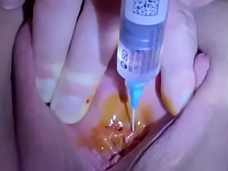 Urethral injection