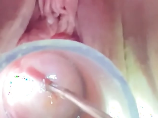 Hegar recommendable probing deep in cervix